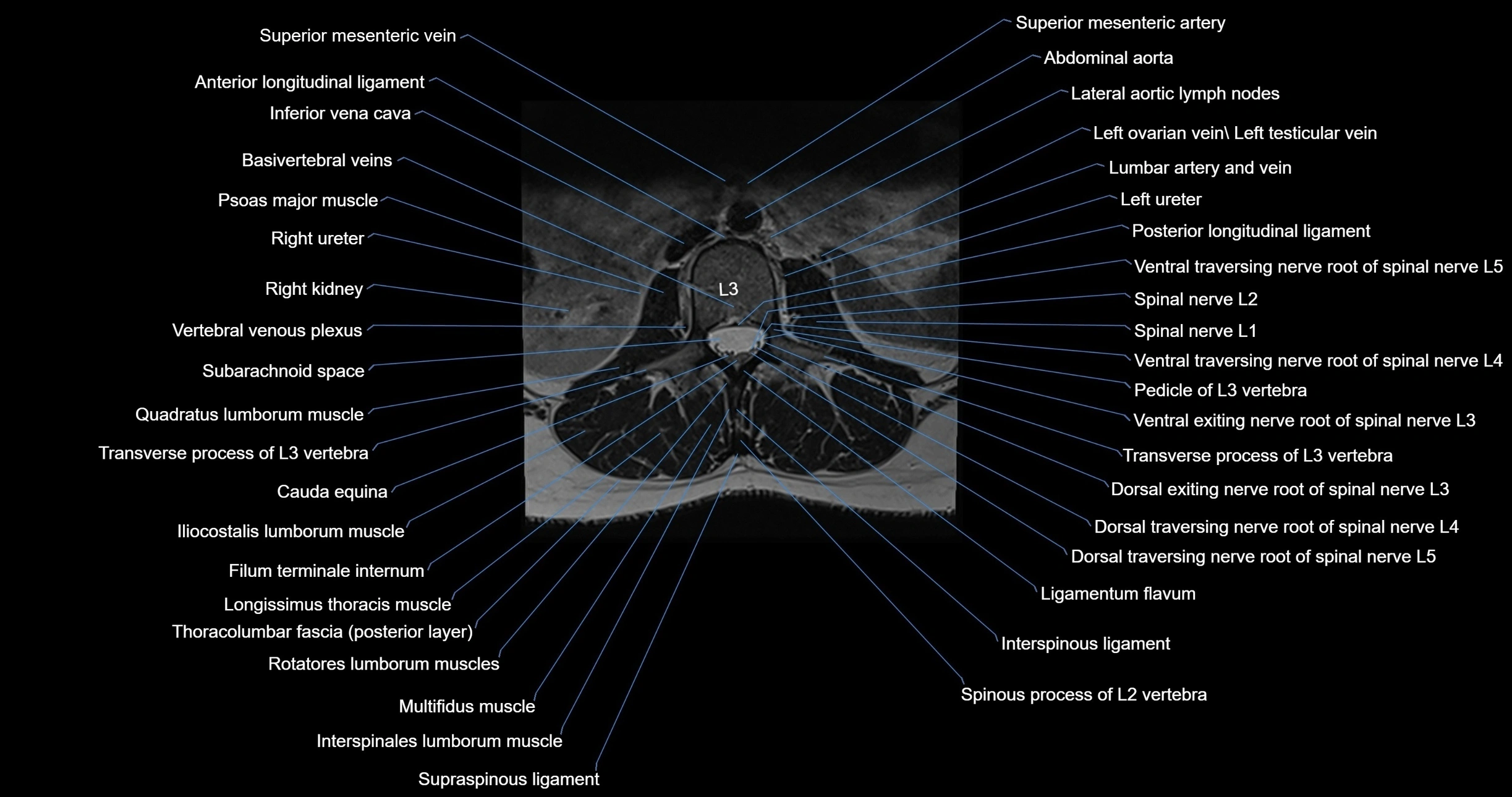 MRI lumbar spine axial cross sectional anatomy 3T radiology  image-img-00001-00022.webp